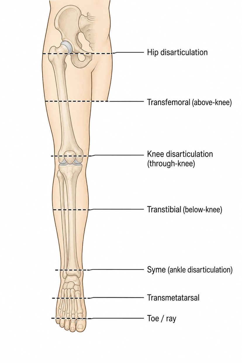 Lower Limb Amputation Levels | OrthoVellum