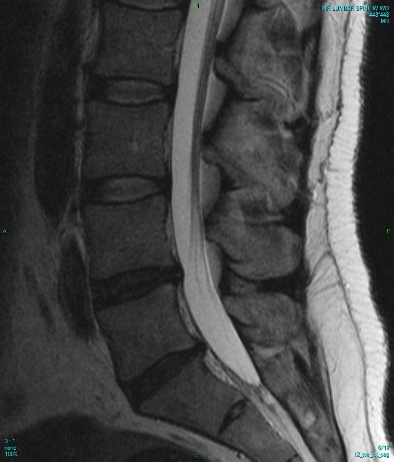 Midline sagittal T2-weighted MRI of the lumbar spine showing a posterior disc herniation at the lumbosacral junction indenting the thecal sac.
