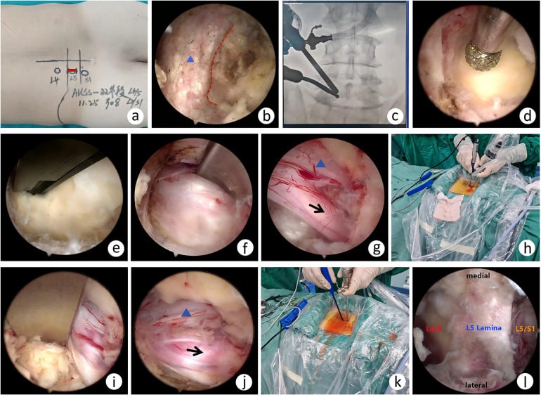 Multi-panel endoscopic sequence showing targeting, limited laminotomy, ligament removal, fragment removal and nerve-root decompression.