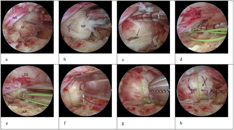 Endoscopic sequence showing the annulus, nucleus pulposus, nerve root and dural sac during lumbar discectomy with annular closure.