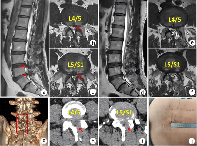 Composite preoperative and postoperative MRI, CT and 3D reconstruction for adjacent L4–L5 and L5–S1 disc herniations.