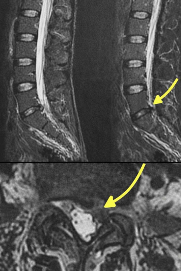 Sagittal and axial lumbar MRI showing a large L5–S1 disc herniation.