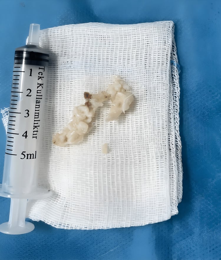 Excised extruded nucleus pulposus fragments displayed on gauze beside a syringe for scale.