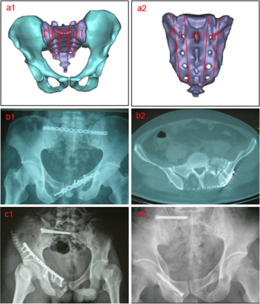 Denis zones I, II and III of the sacrum with radiographs and CT of a vertically unstable sacral fracture before and after fixation.