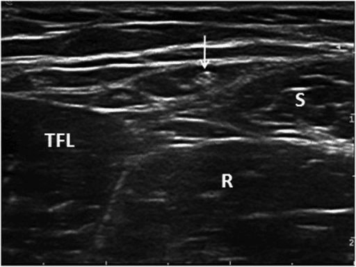 Transverse ultrasound showing the lateral femoral cutaneous nerve between tensor fasciae latae and sartorius.