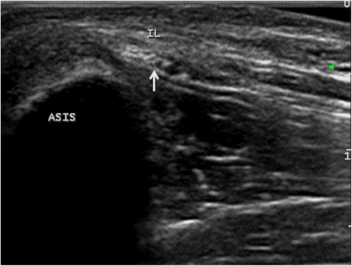 Transverse ultrasound showing the lateral femoral cutaneous nerve passing beneath the inguinal ligament near the ASIS.