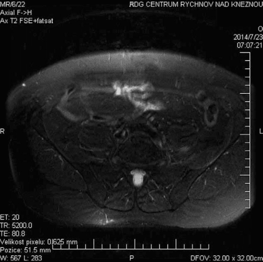 Axial T2 fat-suppressed MR neurography showing oedema along the left lumbar plexus.