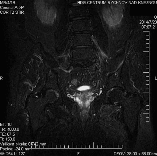 Coronal STIR MR neurography showing oedema of the left lumbar plexus with femoral-nerve swelling.