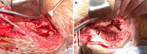 Two-panel operative view showing lumbar nerve roots stretched over an iliac fracture fragment and relaxed after fragment osteotomy.