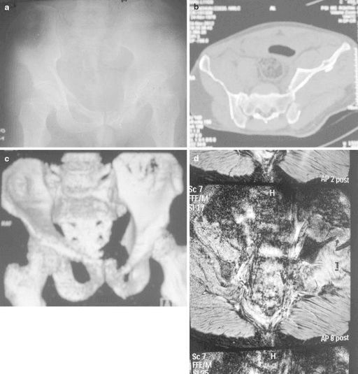 Pelvic radiograph, CT and three-dimensional reconstruction showing an anterior sacroiliac fracture-dislocation with bilateral pubic-ramus fractures.