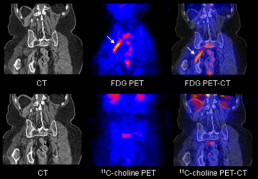 CT, FDG PET and fused FDG PET-CT comparison showing focal right sacral plexus uptake.