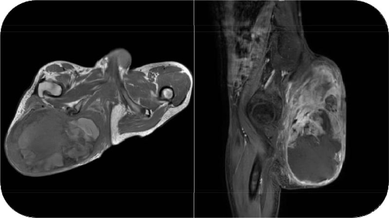 Axial and sagittal MRI showing a large heterogeneous gluteal MPNST.