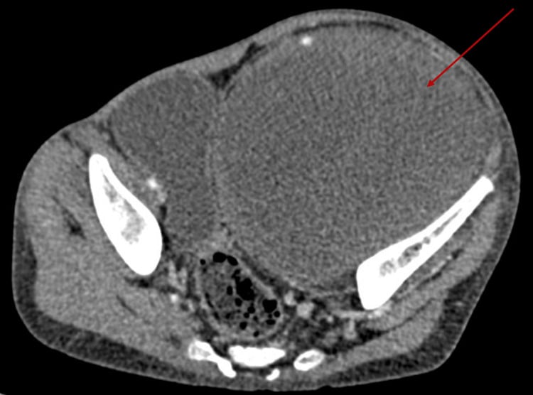 Axial CT demonstrating a large heterogeneous pelvic soft-tissue mass in MPNST.