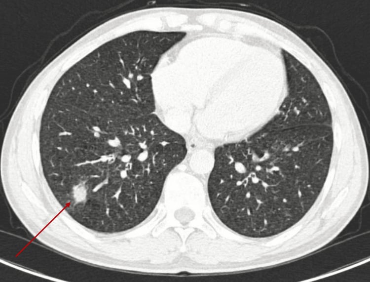 Axial CT of the chest showing a pulmonary nodule suspicious for metastatic MPNST.