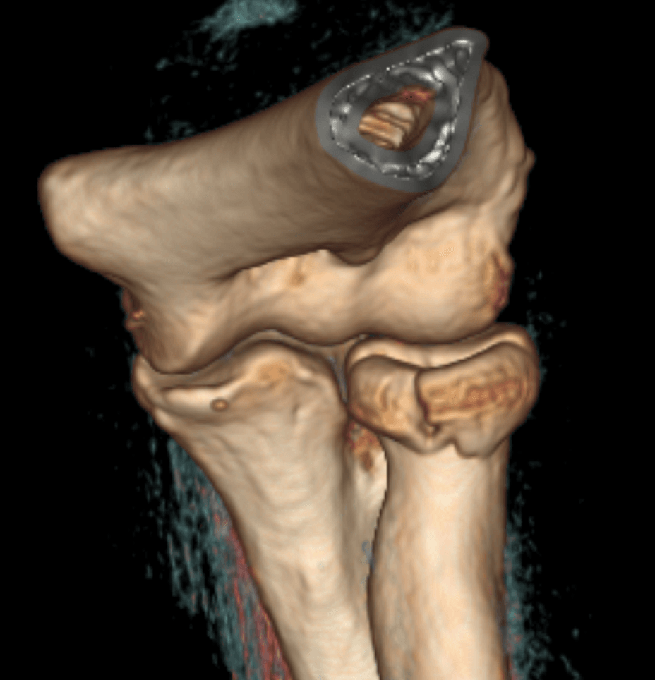 Volume-rendered 3D CT reconstruction of the elbow showing a radial head fracture