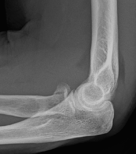 Lateral elbow radiograph showing a radial head fracture with a joint effusion raising the fat pads (sail sign)
