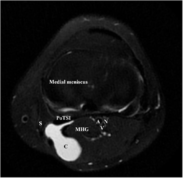Axial T2 MRI of a left knee with a Baker cyst sitting between the medial gastrocnemius and semimembranosus.