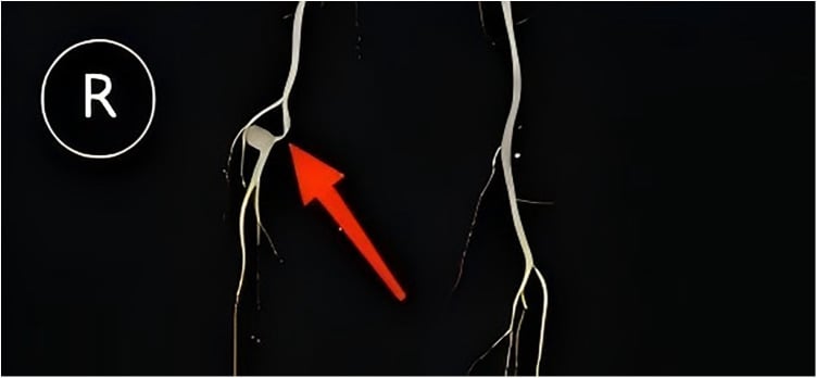 CT angiogram of a 3.7 cm popliteal artery aneurysm with proximal parent-artery stenosis.