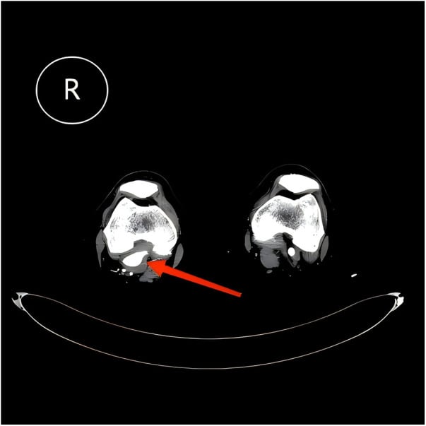 Duplex ultrasound of a 4.1 cm popliteal artery aneurysm with mural thrombus and a residual lumen of 2.2 cm.