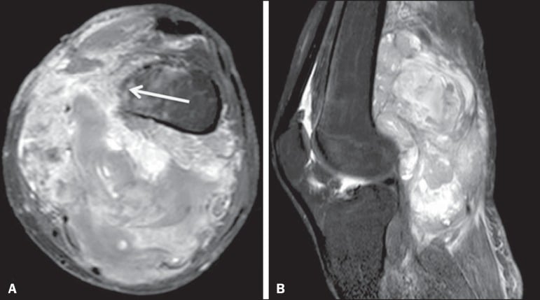 Axial and sagittal fat-suppressed T1 MRI after gadolinium showing an enhancing solid mass in the popliteal fossa.