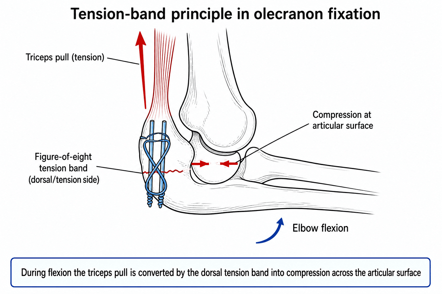 Schematic of the tension-band principle: triceps tension on the dorsal olecranon converted by a figure-of-eight wire into compression at the articular surface during flexion.