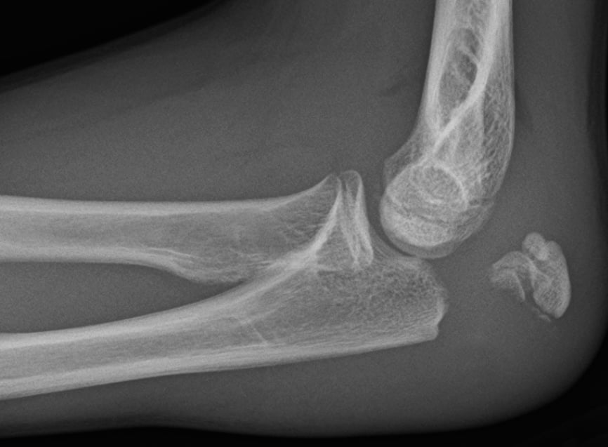 Lateral elbow radiograph of an olecranon fracture with a displaced proximal fragment.