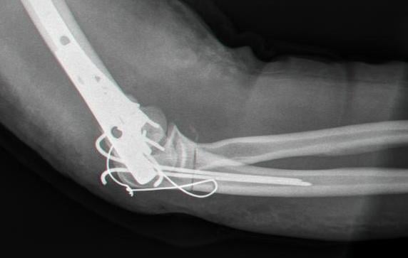 Lateral elbow radiograph showing olecranon tension-band wiring with two K-wires and a figure-of-eight cerclage wire, plus a distal humerus plate.