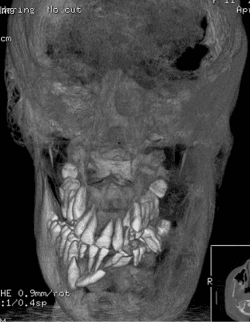 3D CT reconstruction showing craniofacial fibrous dysplasia in McCune-Albright Syndrome