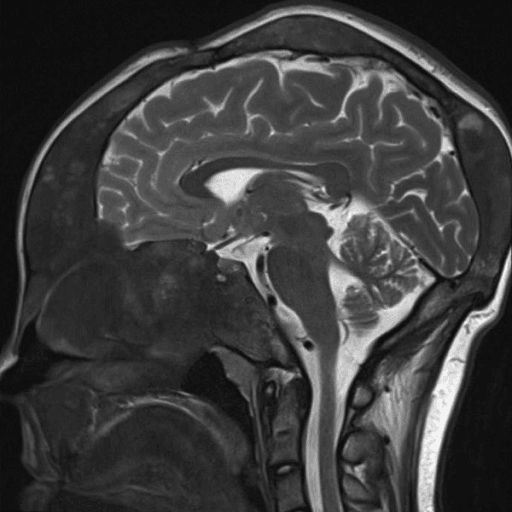 Sagittal T2-weighted MRI showing craniofacial fibrous dysplasia with skull base thickening