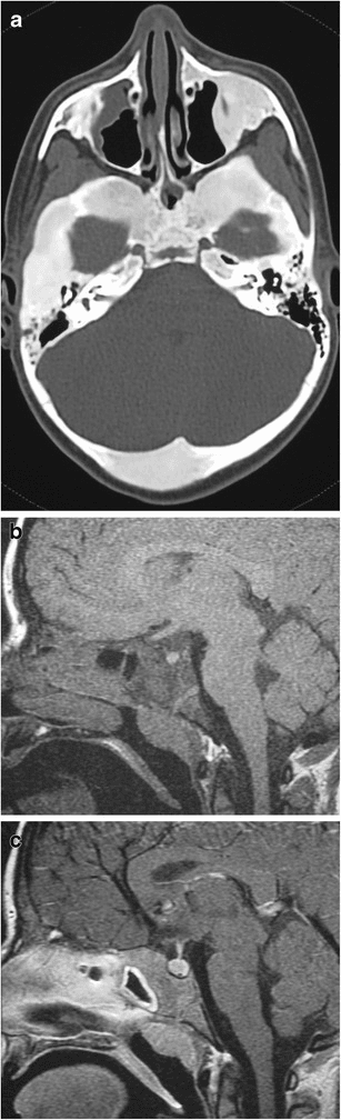 Multimodal imaging of craniofacial fibrous dysplasia in McCune-Albright Syndrome