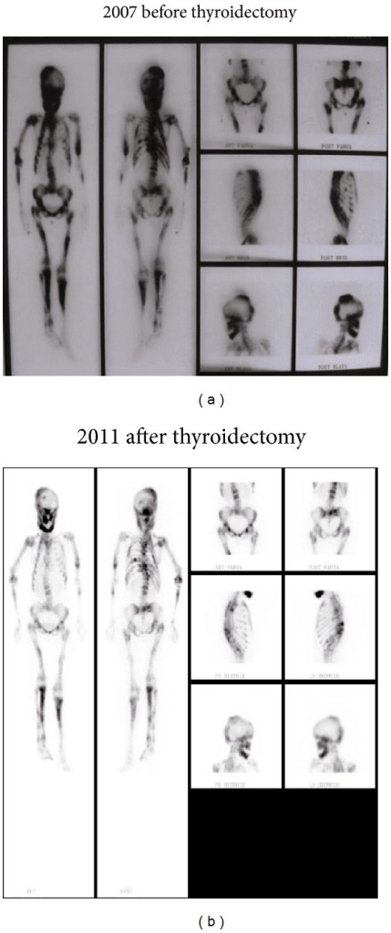 Whole-body bone scintigraphy showing polyostotic fibrous dysplasia distribution