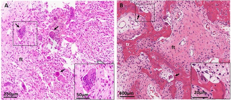 Histology of craniofacial fibrous dysplasia showing irregular woven bone in fibrous stroma