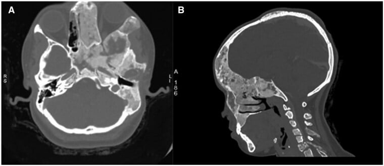 Axial and sagittal CT showing craniofacial fibrous dysplasia and optic-canal narrowing