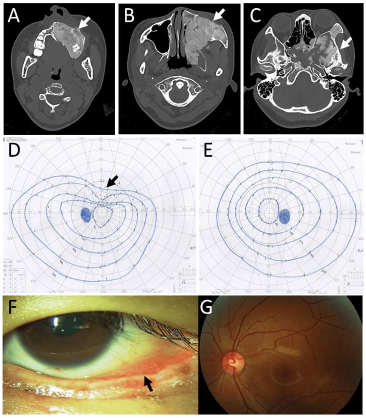 Craniofacial fibrous dysplasia complication surveillance with CT visual fields and ophthalmic assessment
