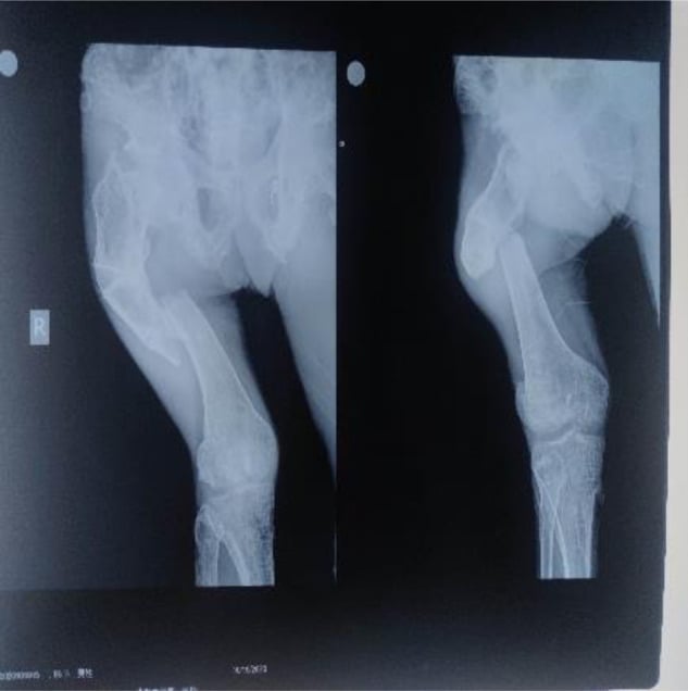Severely deformed femur with pathological shaft fracture and nonunion in polyostotic fibrous dysplasia