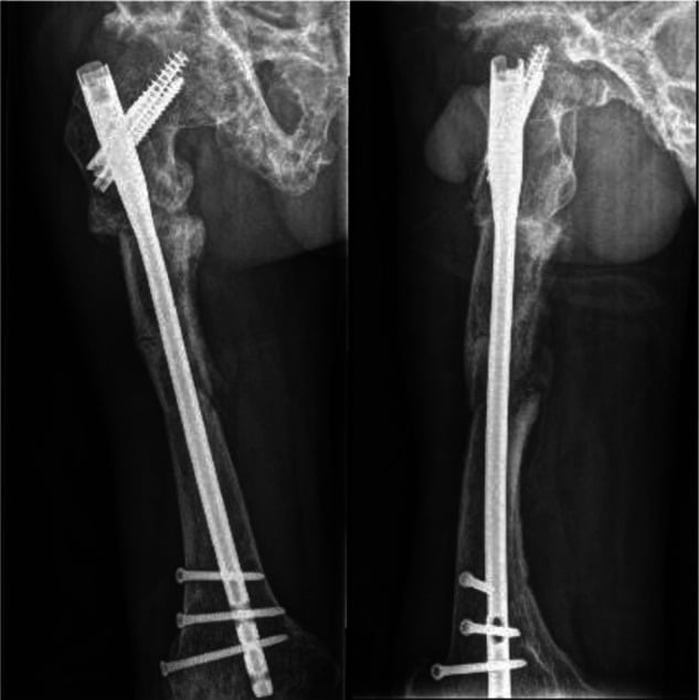 Surgical reconstruction with a long cephalomedullary nail spanning fibrous dysplasia after femoral fracture union