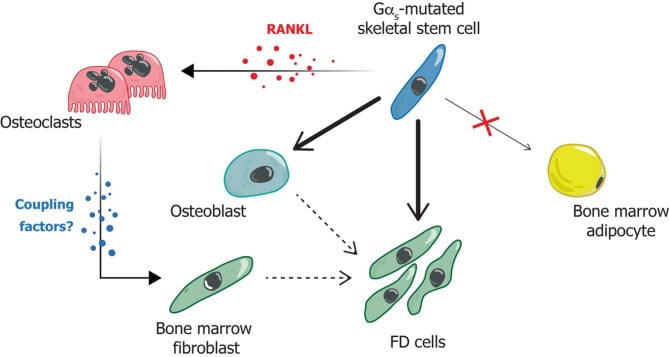 Schematic of mutated skeletal stem-cell differentiation in fibrous dysplasia