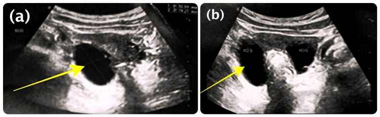 Pelvic ultrasound showing functional ovarian cysts in peripheral precocious puberty