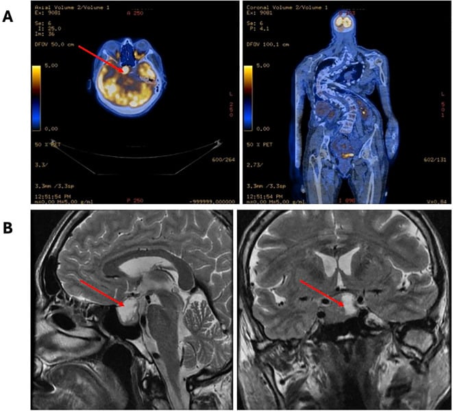 Sellar PET CT and pituitary MRI showing a pituitary adenoma in McCune-Albright syndrome