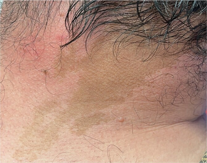 Irregular cafe-au-lait macule on the side of the neck in McCune-Albright syndrome