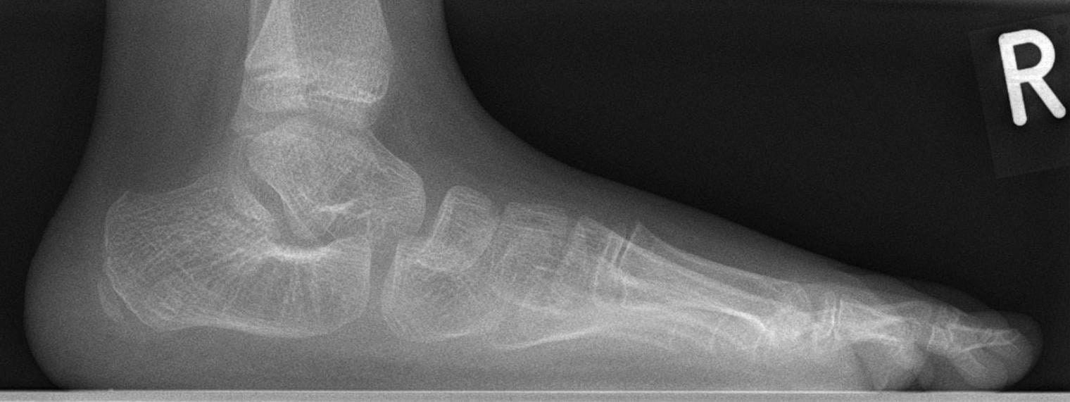 Lateral standing radiograph of a flat foot (pes planus) with the talus plantarflexed and a plantar-apex Meary angle