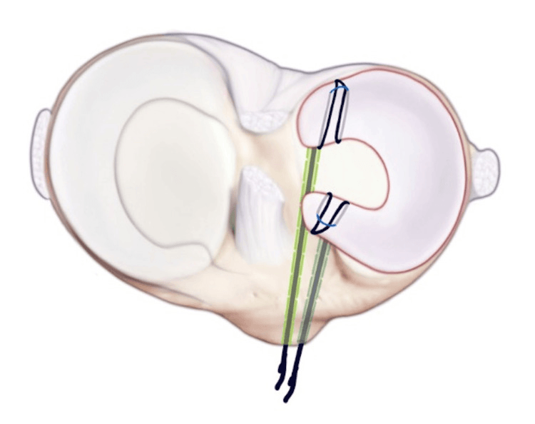 Illustration of meniscal allograft horn sutures passing down two tibial tunnels