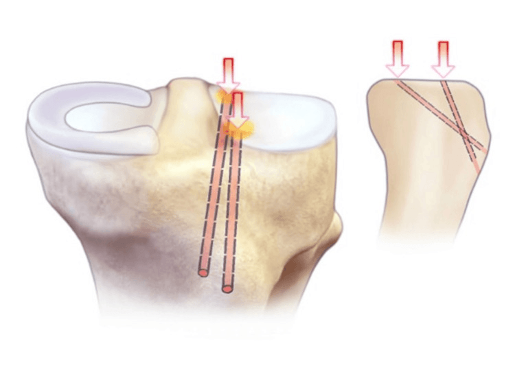 Illustration of two separate tibial tunnels drilled to the anterior and posterior meniscal root footprints