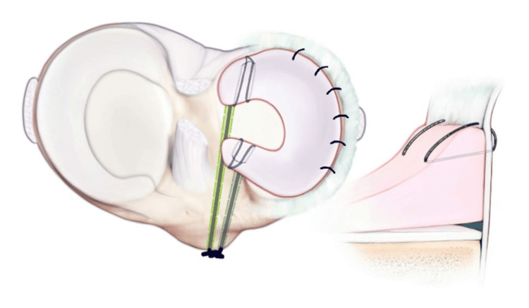 Illustration of a meniscal allograft fixed at both roots and sutured circumferentially to the capsule