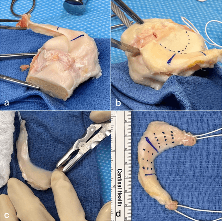 Back-table preparation of a donor meniscus from its tibial plateau, panels a to d