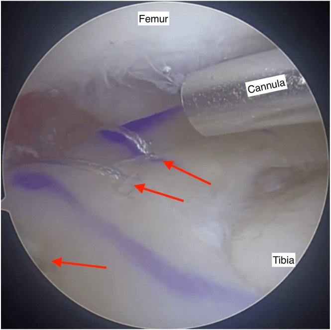 Arthroscopic view of peripheral sutures, marked by red arrows, securing a meniscal allograft