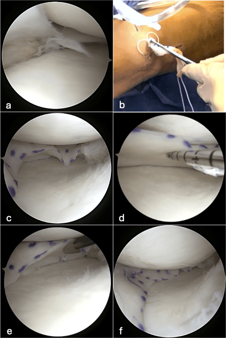 Six-panel sequence of meniscal allograft implantation, panels a to f