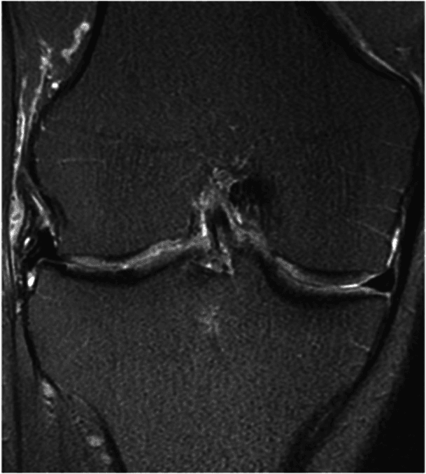 Coronal MRI showing near-complete extrusion after lateral meniscal transplantation