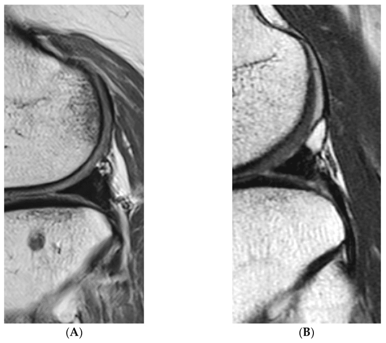 Two MRI examples, A and B, from a grading of meniscal allograft signal intensity
