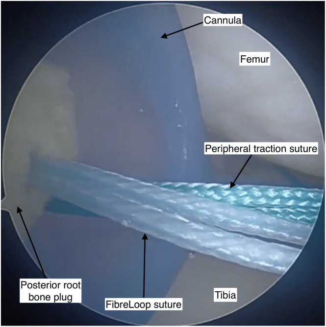 Arthroscopic view of the posterior root bone plug entering the joint on FibreLoop and peripheral traction sutures